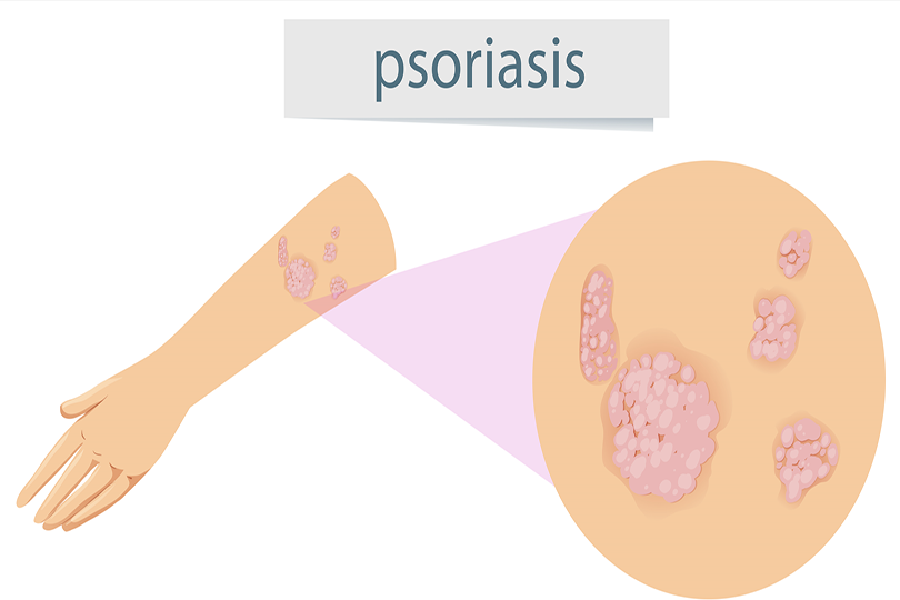 symptoms eczema