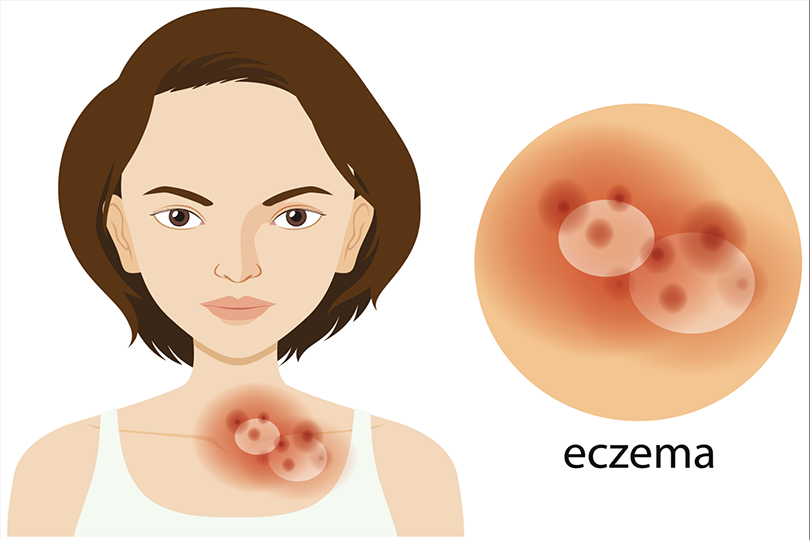 eczema